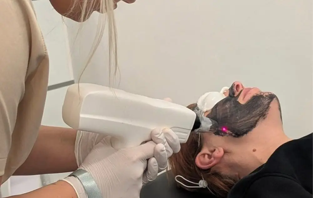 Laser passing over the carbon mask during a carbon facial