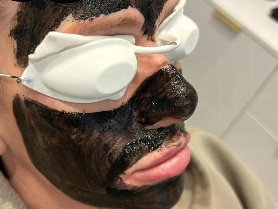 Carbon mask applied with protective eye shields