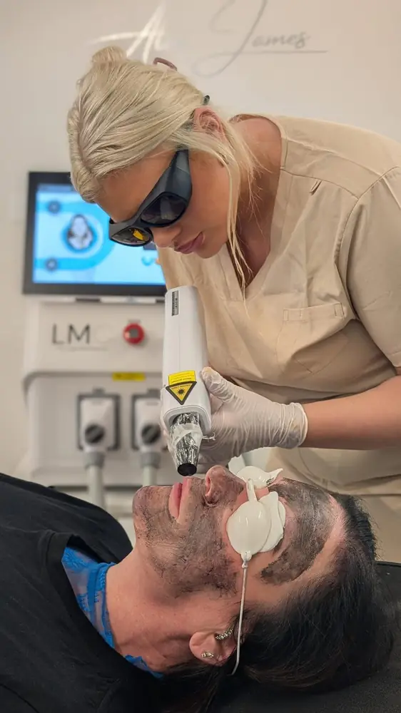 Carbon laser facial treatment