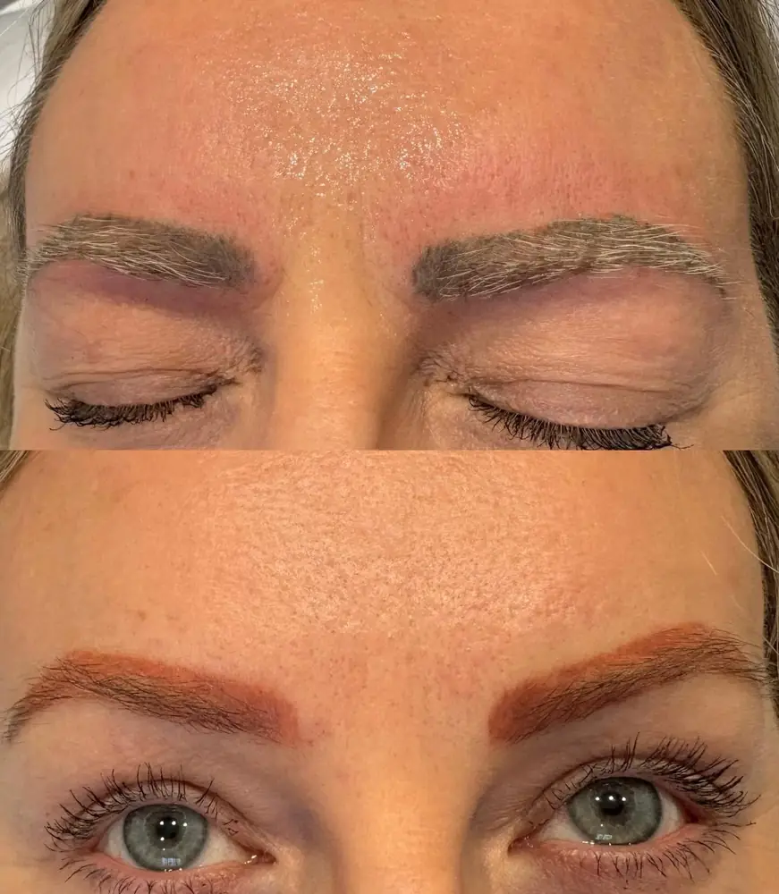 Brow SPMU before and straight after laser removal