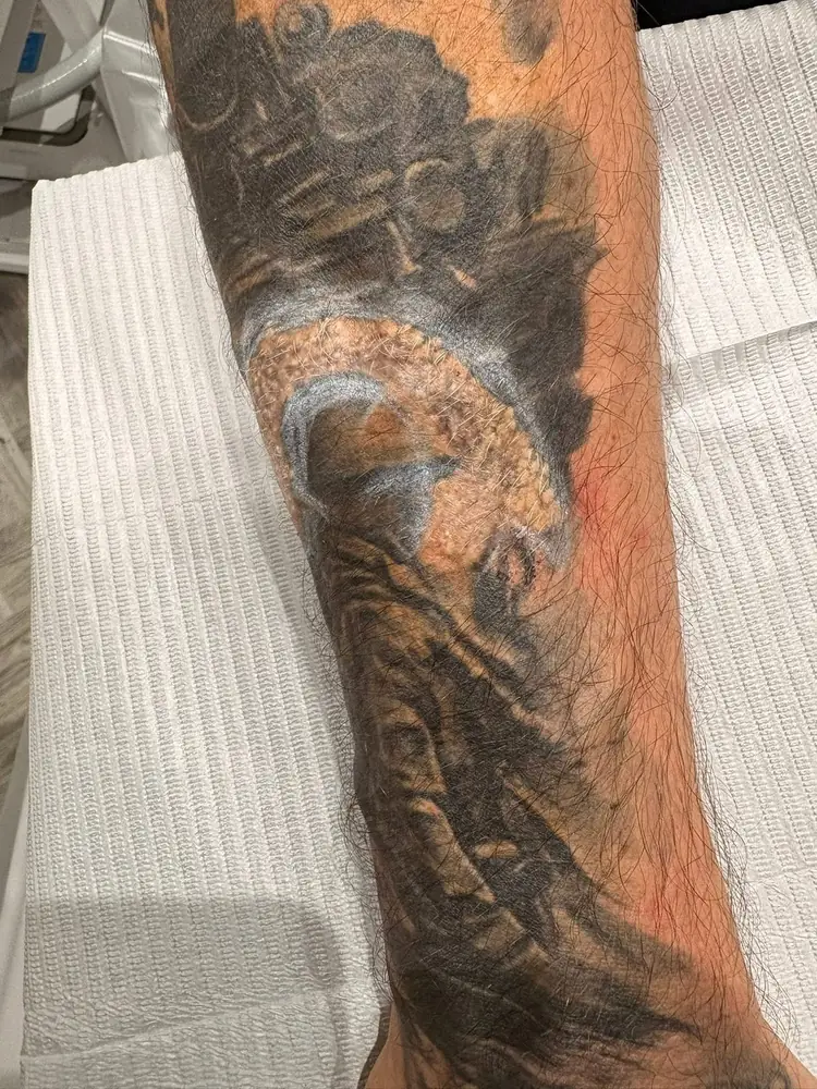 Forearm tattoo straight after a laser tattoo removal session