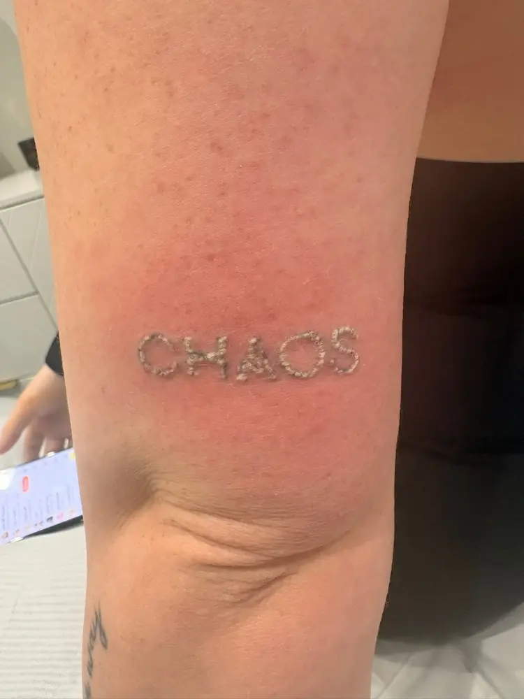The same tattoo immediately after a laser session, showing the white frosting reaction