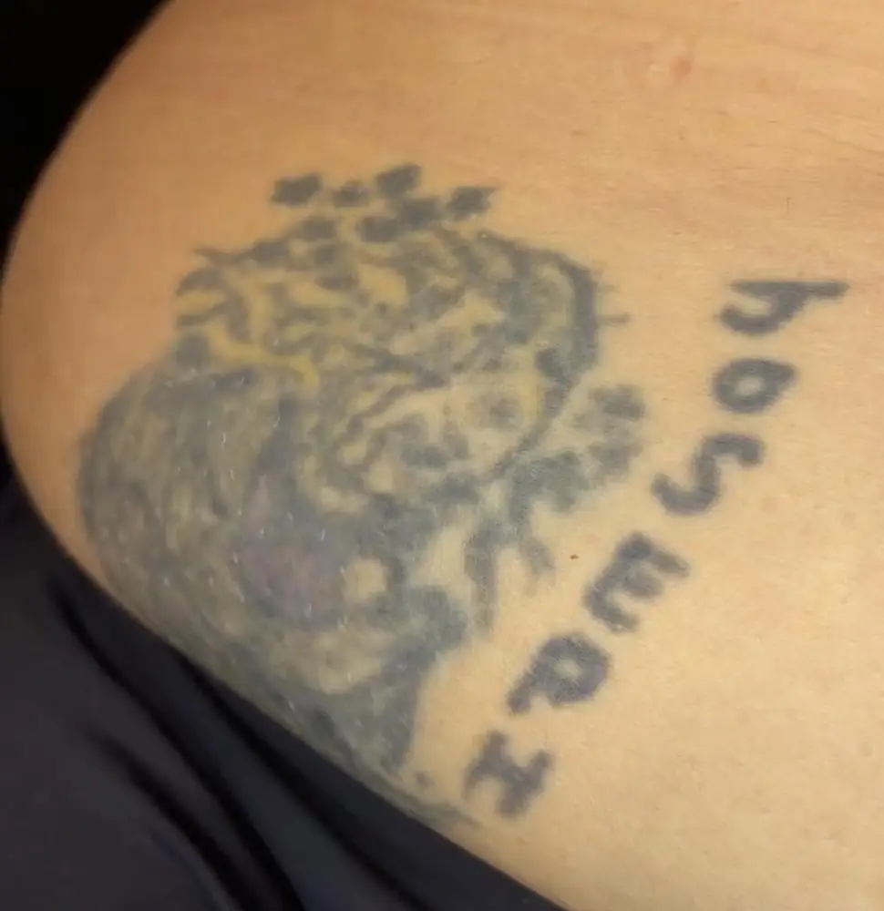 Name tattoo before laser tattoo removal