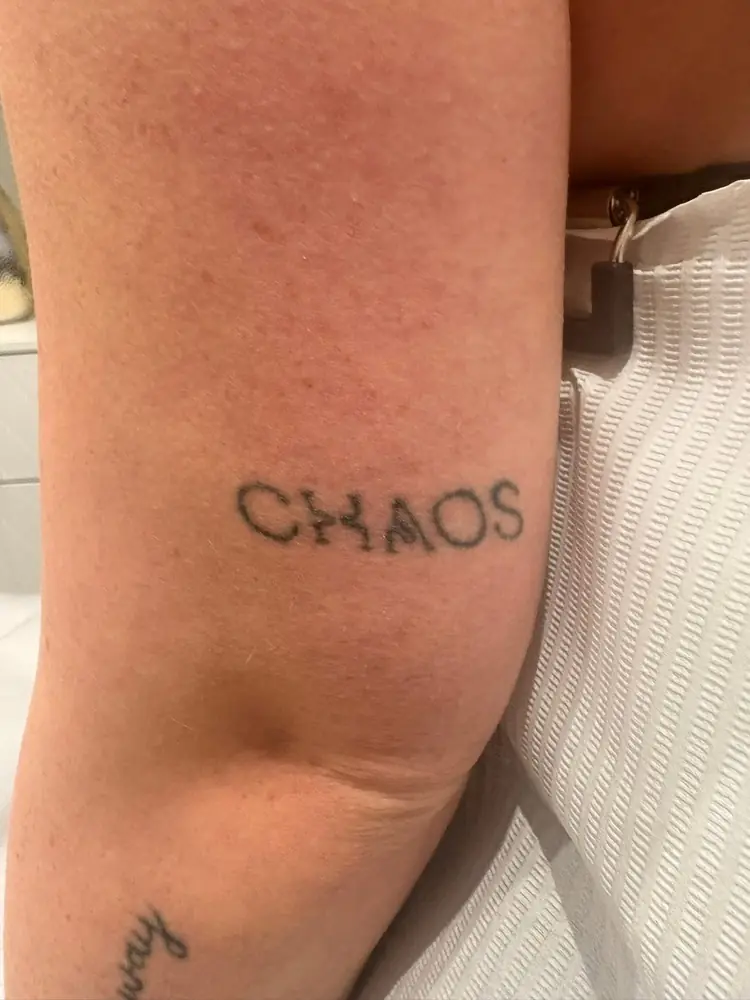 Script tattoo before laser tattoo removal