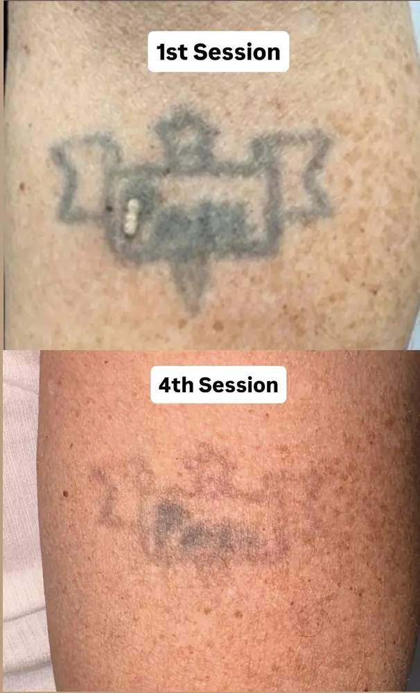 Tattoo at the first session and at the fourth session
