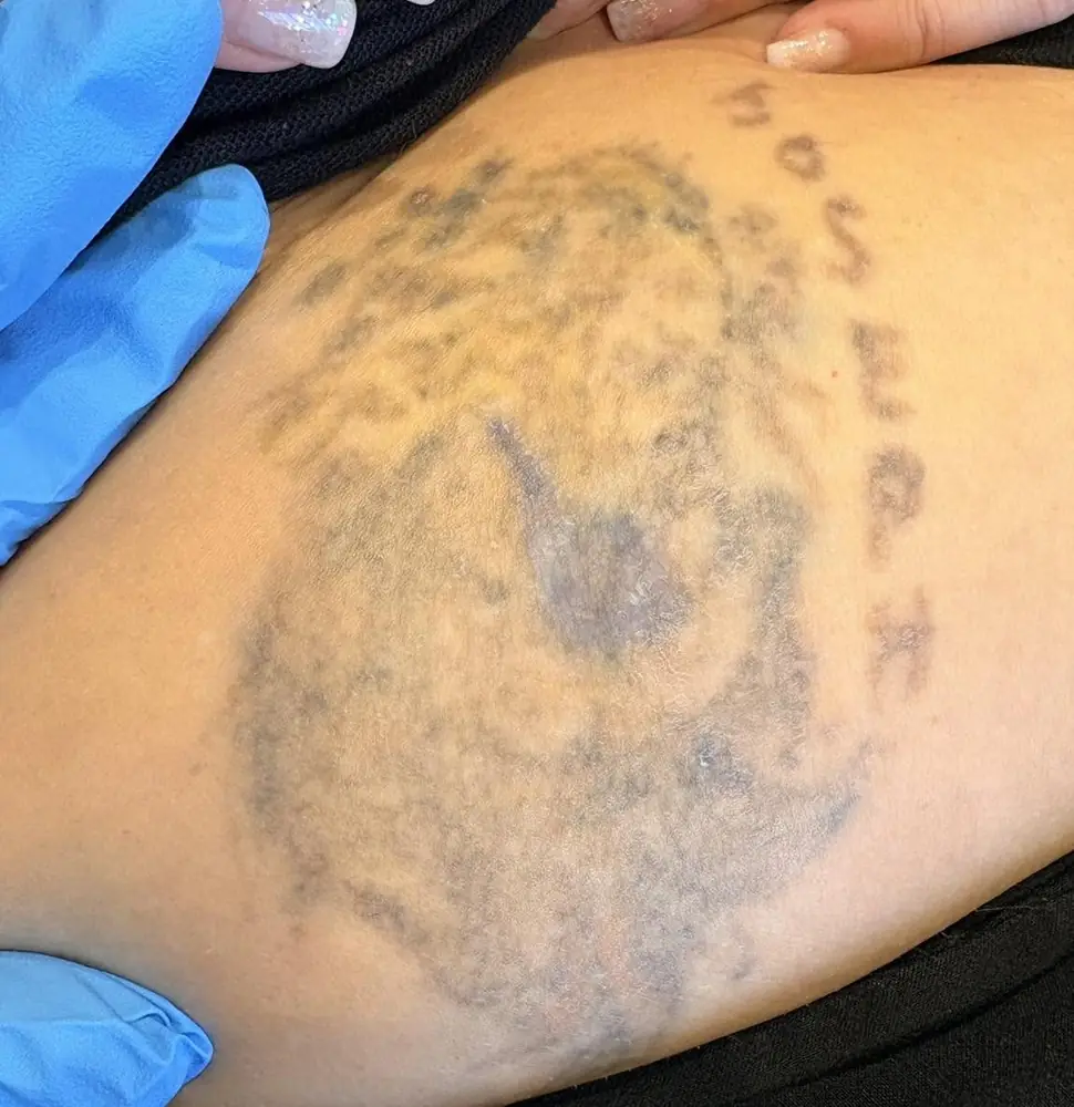 The same tattoo noticeably faded during a course of laser tattoo removal