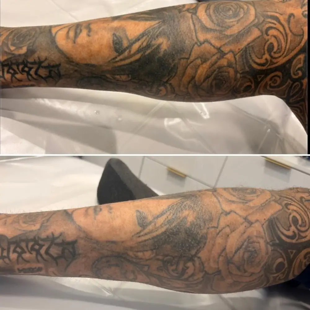 Leg sleeve tattoo before and during a course of laser tattoo removal