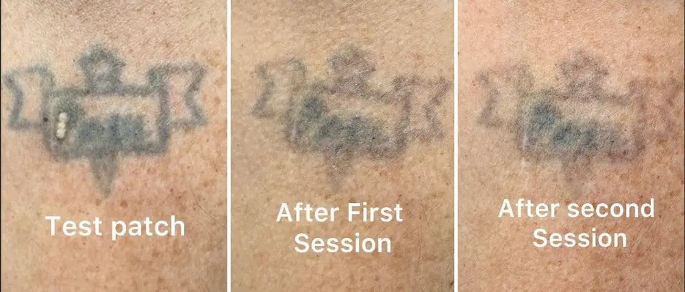 Tattoo at test patch, after the first session and after the second session
